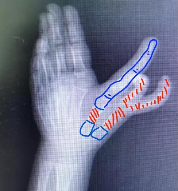 一种罕见的手先天畸形玉骨手外二科为慕名求医者重建未来